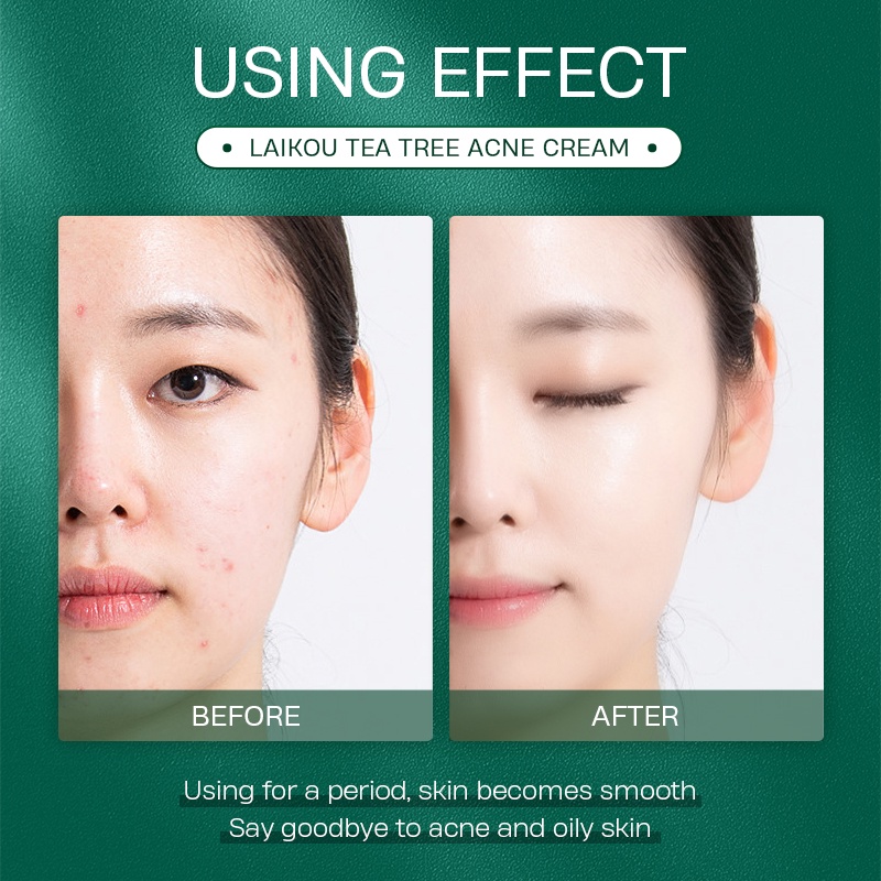 LAIKOU Tea Tree Acne Cream Jerawat Menenangkan Kulit Kemerahan Bekas Jerawat 20g