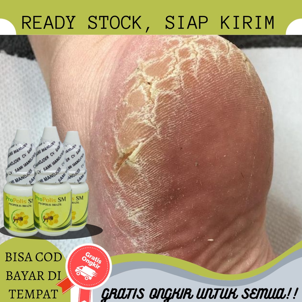 Obat Belah - belah Telapak kaki, Obat Tumit Pecah - pecah dan kering, Obat Kaki Pecah - pecah, Obat 