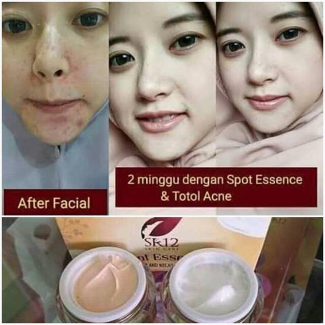 TUMPAS FLEK HITAM TERAMPUH Spot Essence SR12 Day &amp; Night Cream BPOM FLEK HITAM BEKAS JERAWAT BLILA