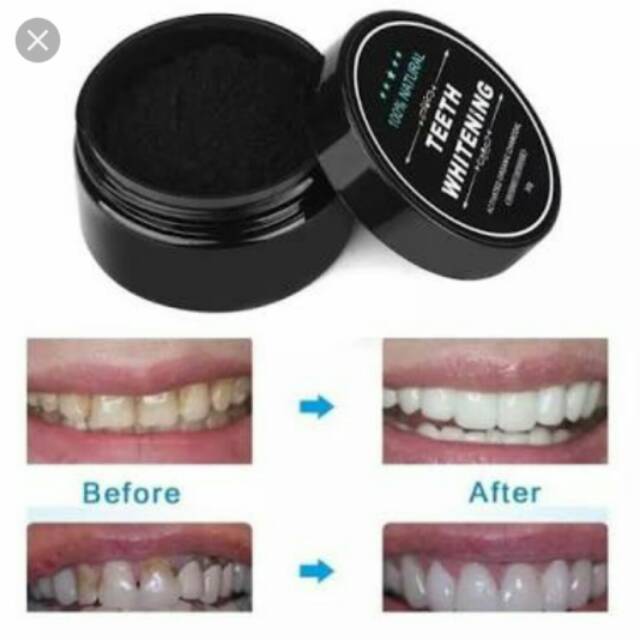 Teeth whitening