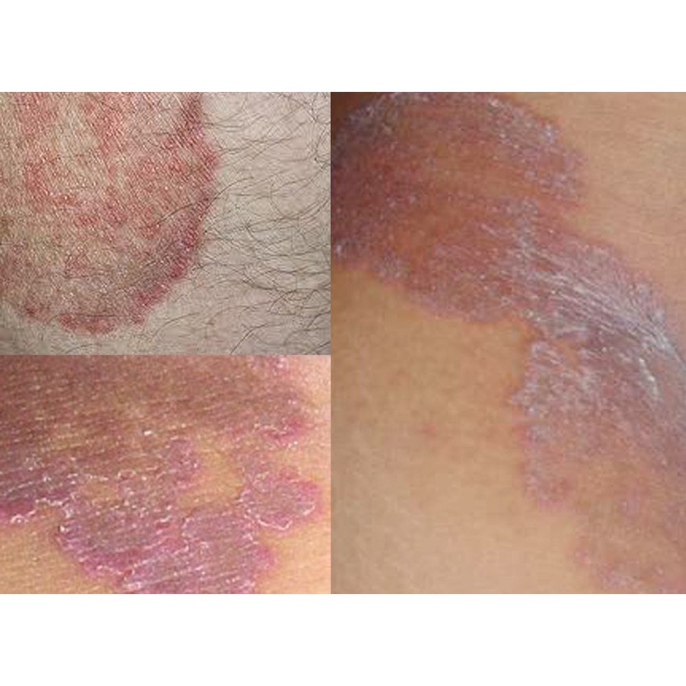 Promo Obat Anti Gatal Jamur Kulit Selangkangan Paha- Salep Krim Oles Racikan Diskon