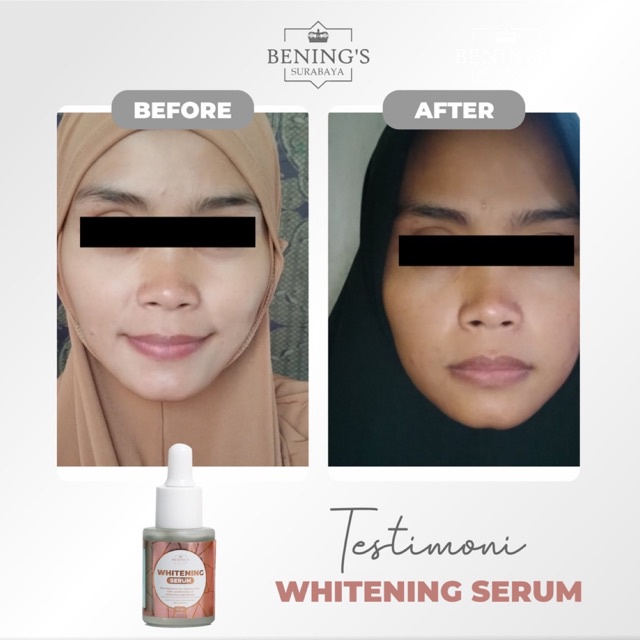 BENING'S WHITENING SERUM KULIT KUSAM DR OKY PRATAMA