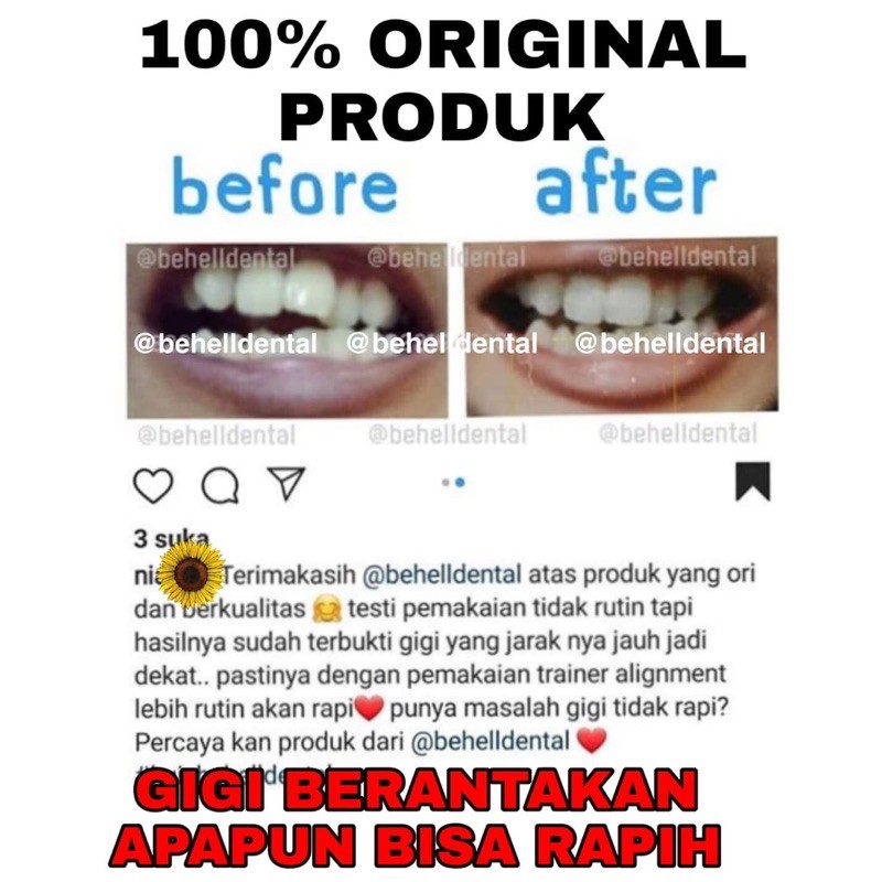 PERAPIH GIGI BEHELLDENTAL ORIGINAL / ALAT PELURUS TANPA BEHEL / TEETH TRAINER RETAINER ALIGNMENT 100% ORI ASLI - Dental Perata Gigi