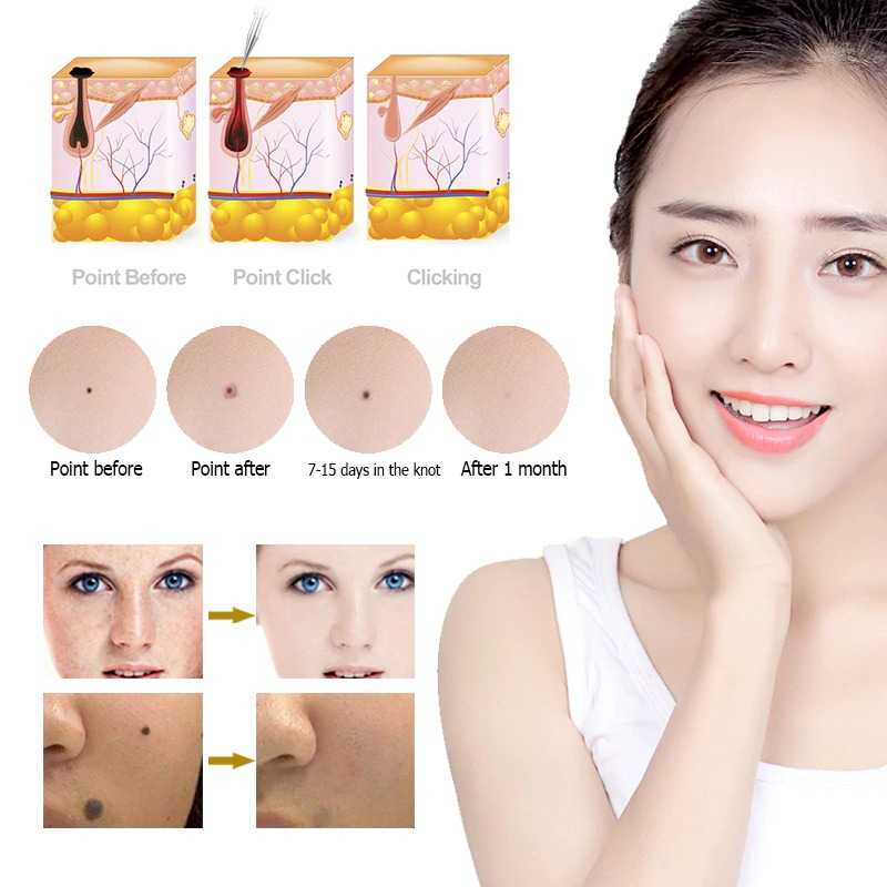 Pen Laser Plasma Penghilang Jerawat Dark Spot Wajah KENAIYA - 7CHR08GD