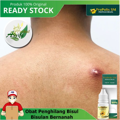 Obat Penghilang Bisul / Bisulan Bernanah - Infeksi Kulit Benjolan Bisulan