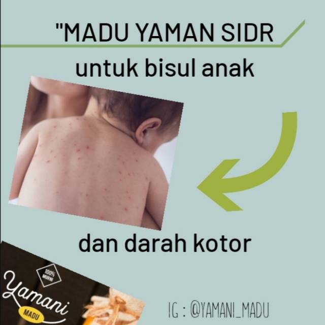 

MADU YAMAN SIDR UNTUK BISUL DAN DARAH KOTOR