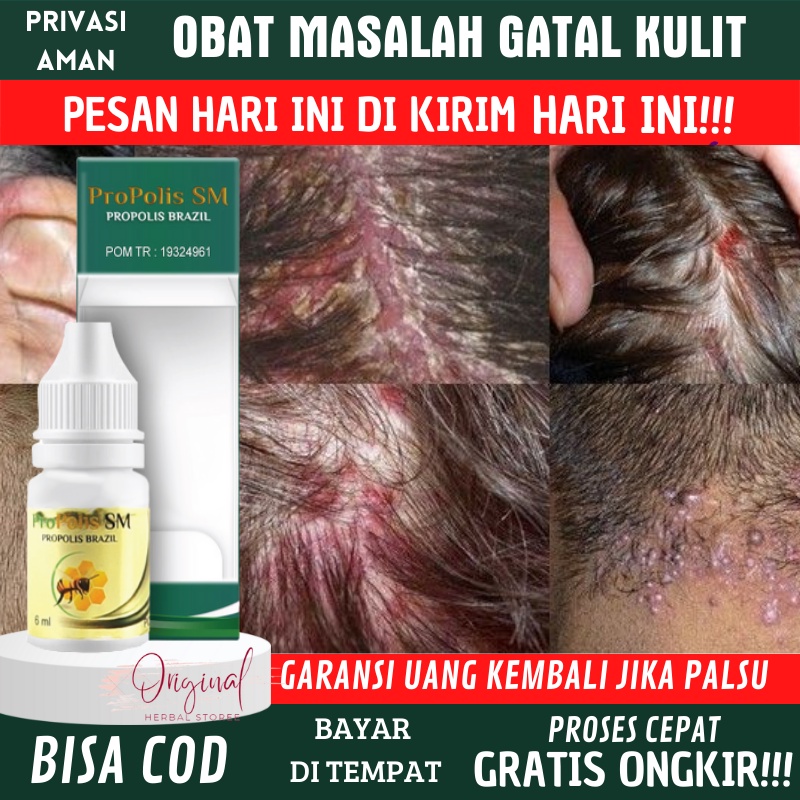 Obat Borok kepala, Obat koreng kepala, Obat ketombe berkerak, Obat Ketombe menahun, Obat tetes ketom