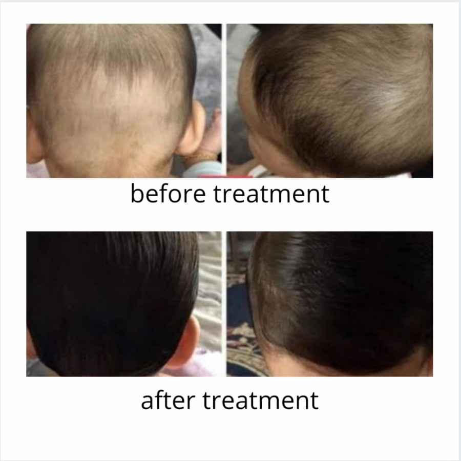 Minyak Kemiri Bali Murni - Solusi Rambut Rontok - Penumbuh Rambut Lebat ( Candlenut Kukui Oil) Alis Jenggot Kumis Bulumata Jambang-2