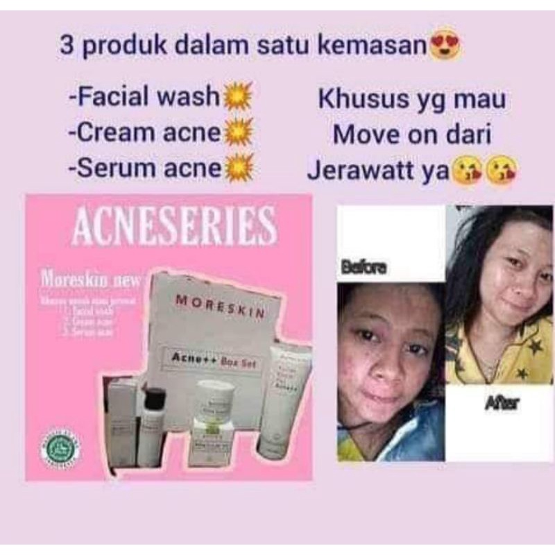 Moreskin Acne Series