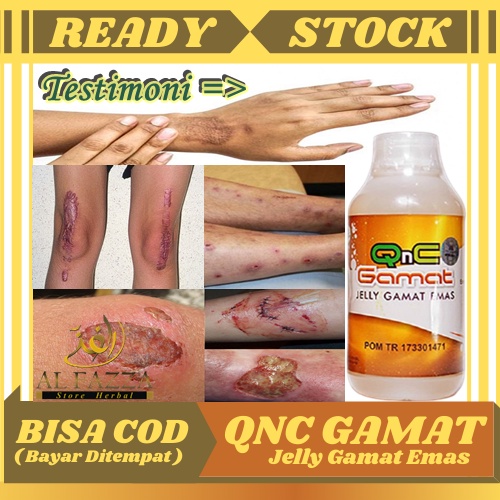 Obat Pengering Luka, Penghilang Luka Bakar, Pembersih Bekas Luka, Luka Koreng / Gatal / Lama / Hitam