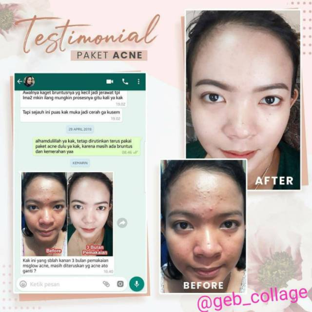 Ms Glow #Free Gift Acne Series Original Barcode Msglow Original - Paket Acne Basic (Paket Jerawat)-3