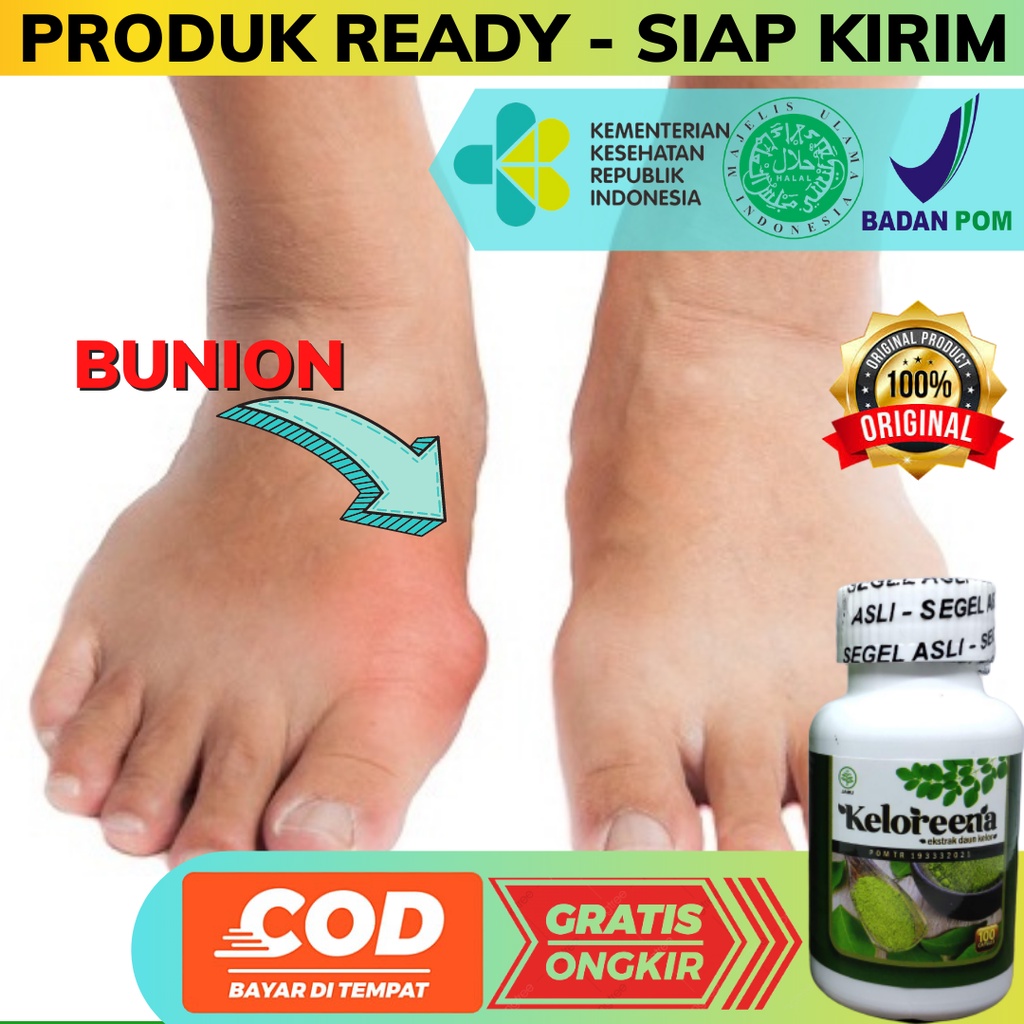 Jual Obat Bunion Obat Benjolan Tulang Di Pangkal Jempol Kaki Obat