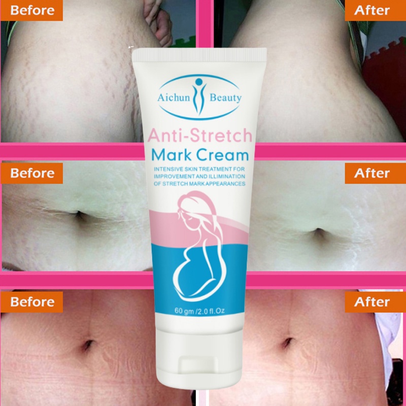 Stretchmark Stretch mark cream Krim stretch mark krim penghilang bekas luka 60ML Secara efektif menghilangkan stretch mark Menghilangkan stretch mark dengan cepat dalam seminggu Memudarkan bekas luka Onset cepat Tersedia untuk ibu hamil