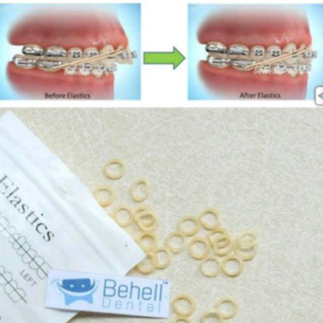 100pcs DENTAL KARET BEHEL GIGI ELASTIS / Rubber Band Elastic Untuk Perbaikan Gigi / Karet Ortho / Orthodontic Orthodontics Behelldental Kawat Gigi Ukuran 1/4 1/8 3/8 3/16 5/16 ketebalan 3.5 5 6.5 oz