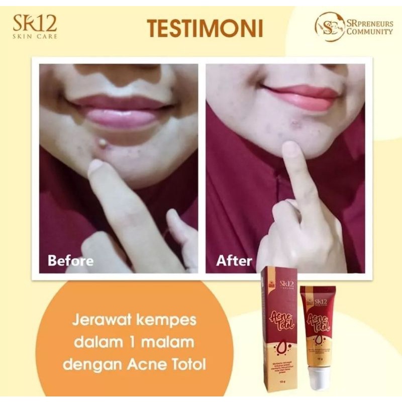 ACNE TOTOL SR12/CREAM OBAT JERAWAT AMPUH/JERAWAT HORMONAL KEMPES KERING MERADANG KEMPES SEMALAM/ACNE