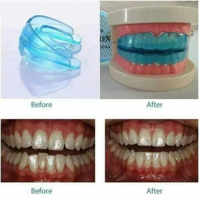 [CEV] Alat Perapi Perata Gigi Orthodontic Retainer Teeth Trainer Alignment