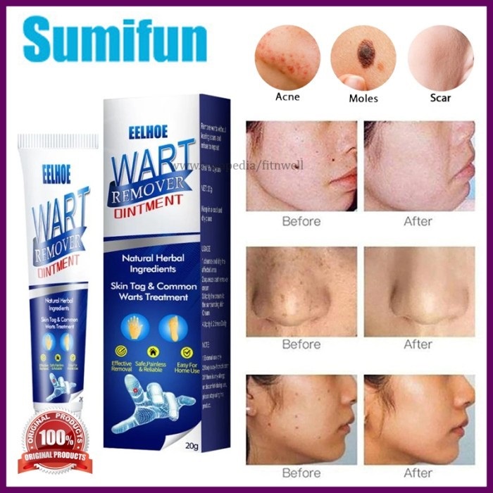 Sumifun Wart Remover Skin Tag Tahi Lalat Mata Ikan Milea Kutil 20g