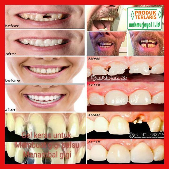 Wrzgf46d Gigi Palsu Temptooth Temporary Tooth Lem Tambal Gigi Instan Kuat A Stick It Kecil Shopee Indonesia