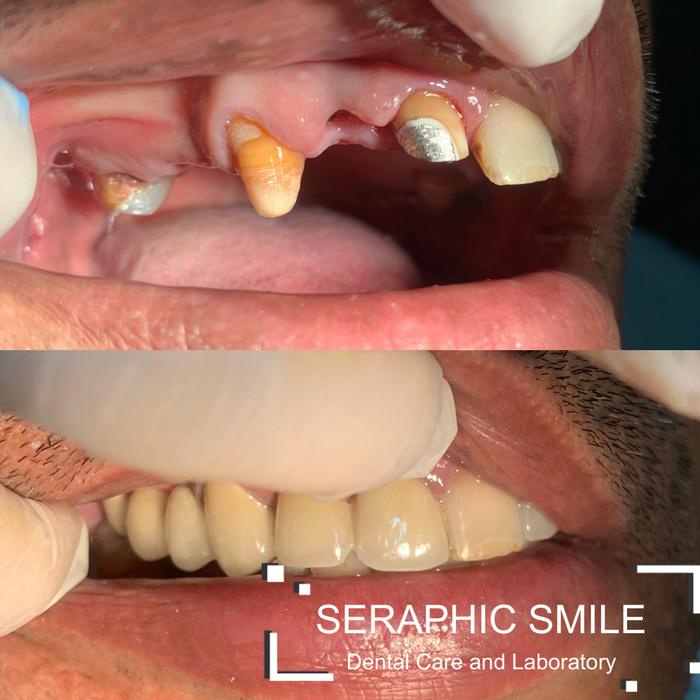 Vier | Gigi Palsu Metal Porselen / Jacket Crown / Pelindung Gigi Rusak