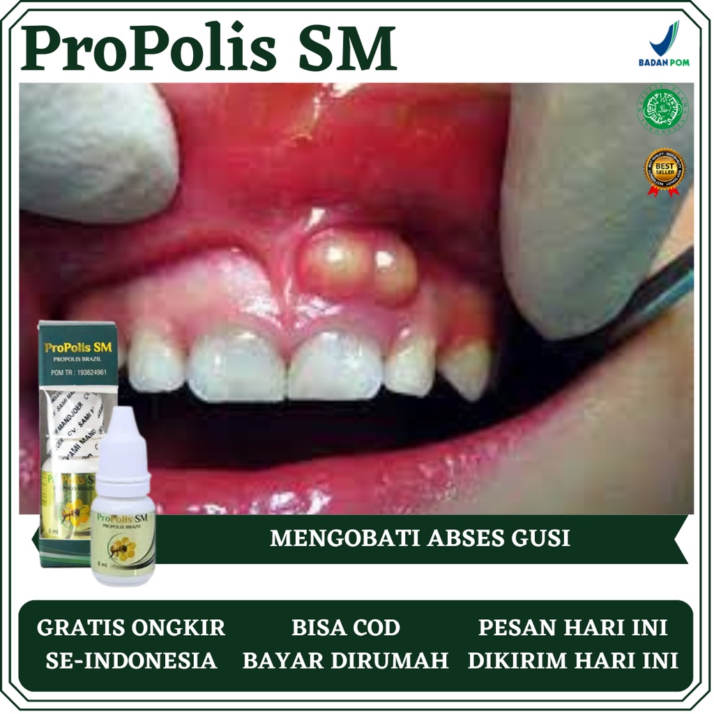 Obat Abses Gusi, Obat Gusi Bengkak, Obat Gusi Sakit, Obat Gusi Berdarah, Obat Gusi Bernanah, Obat Ra