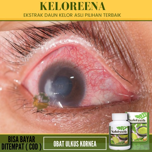 KELOREENA - Obat Ulkus Kornea Alami, Luka Pada Kornea mata, Infeksi kornea mata, obat kornea mata lu