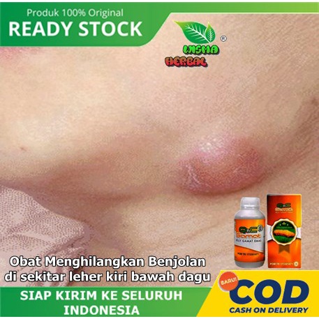 Obat Menghilangkan Benjolan di sekitar leher kiri bawah dagu - Obat kelenjar getah bening - Obat Mas