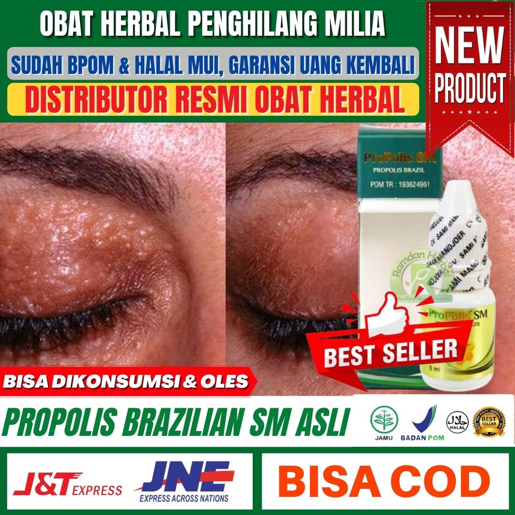 Obat Herbal Alami Milia, Milia Di Wajah, Milia Di Bibir, Milia Di Kening, Milia Di Kelopak Mata, Mil