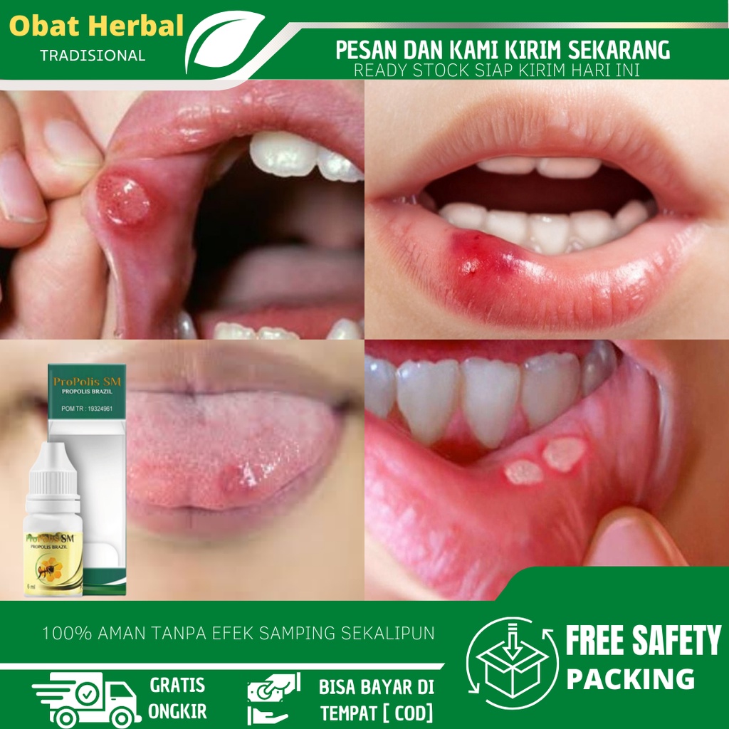 Obat Alami Sariawan, Sariawan di Bibir, Obat Sariawan Akut, Sariawan Tak Kunjung Sembuh, Benjolan Di