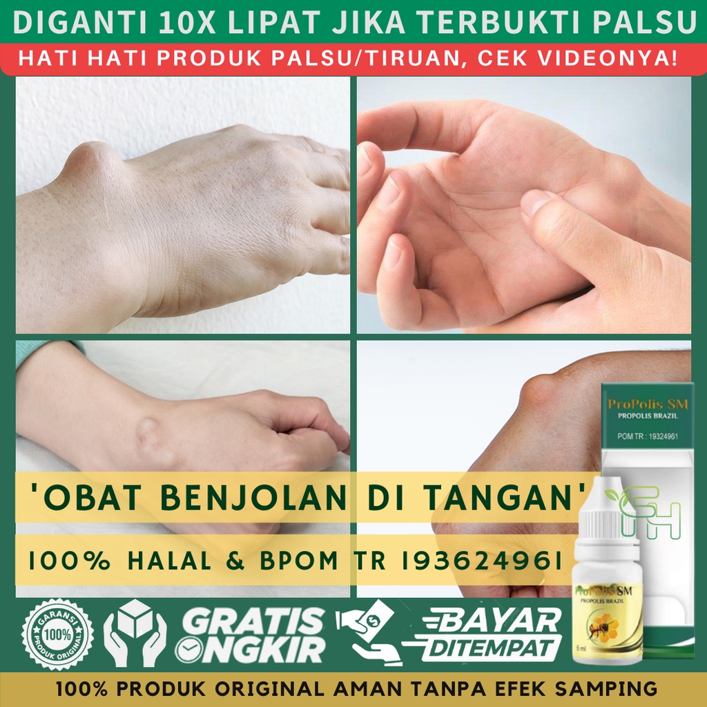 Jual Obat Penghilang Benjolan Di Tangan, Kista Ganglion, Benjolan Di ...