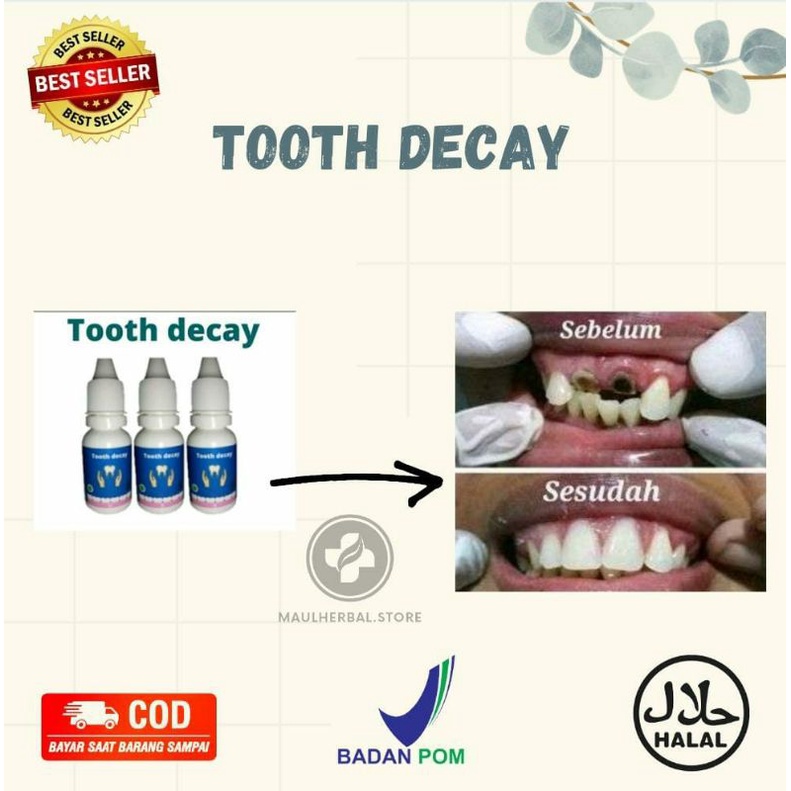 TOOTH DECAY ( PENUMBUH GIGI, PENGHILANG KARANG GIGI, GIGI KROPOS )