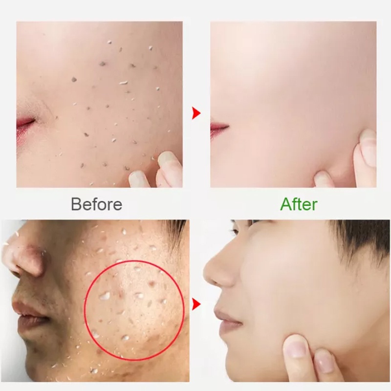 GIRLPAL CENTELLA ASIATICA PEELING GEL Facial Glowing Blackhead Cleaner Body Exfoliating Skincare Face Scrub