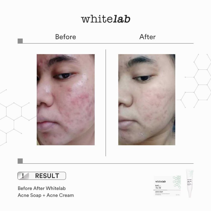 Whitelab Acne Soap - Sabun Wajah Dan Badan Untuk Kulit Berjerawat BPOM Original