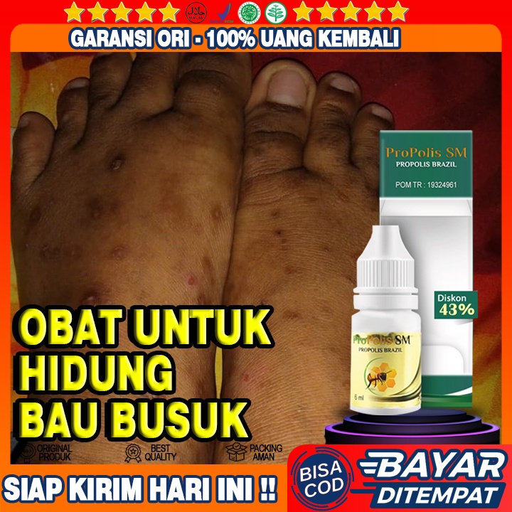 Obat Darah Manis, Kulit Gatal-Gatal, Prurigo, Bintil-Bintil Bernanah, Penghilang Bekas Luka Kulit