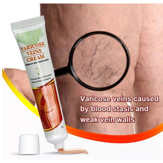 OBAT CREAM HILANGKAN VARISES SEMBUH PERMANEN - CREAM VARICOSE VEINS