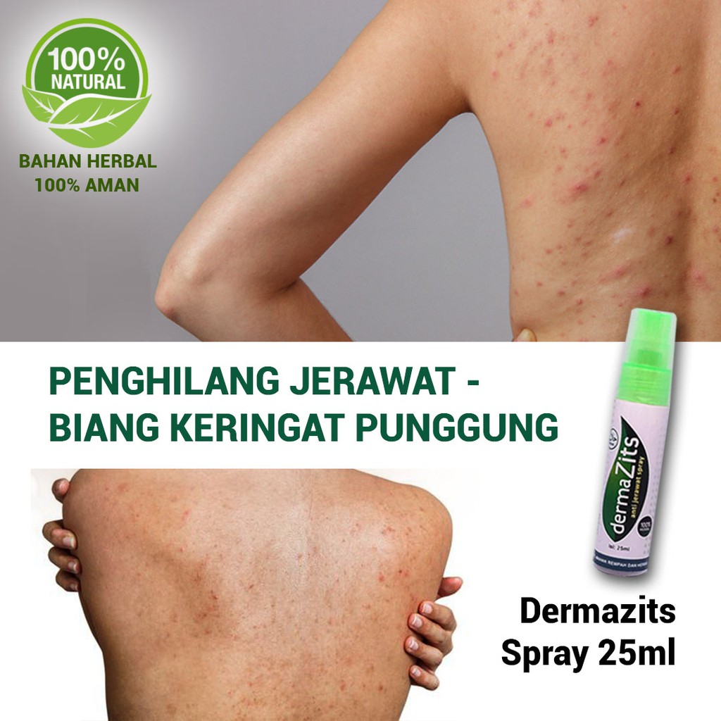 OBAT JERAWAT PENGHILANG BIANG KERINGAT PUNGGUNG - Dermazits 25ml