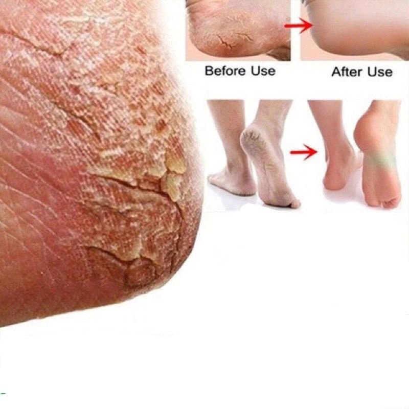 Alat Pembersih Kapalan Kerokan Kaki Pisau Penghilang Kulit Mati Kaki Anti Kasar Pedicure Credo Soligen / Credo pedicure skin shaver corn cuticle remover file foot/ Callus remover