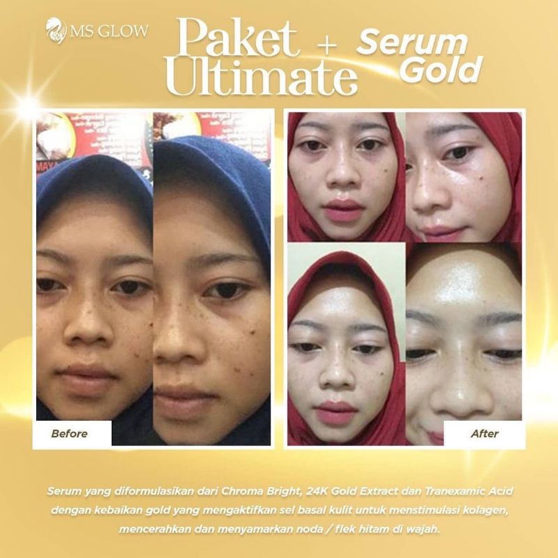 WHITENING GOLD SERUM MSGLOW, SERUM FLEK NODA HITAM SERUM SULTAN ANTI AGING