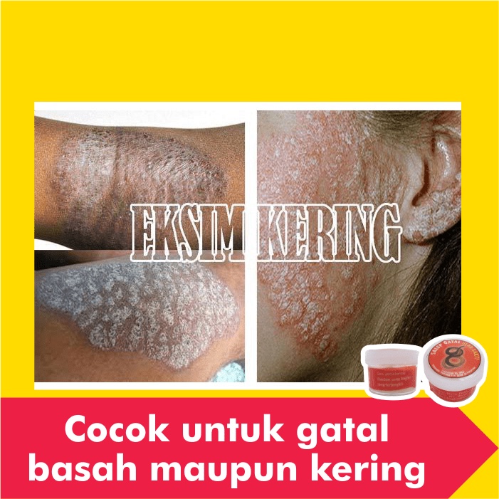 Salep Obat Gatal Eksim Kering Menahun Paling Ampuh Kulit Gatel Exim Basah Saleb Selangkangan Kurap Kutu Air Luka Diabetes Panu Kudis Kadas-4