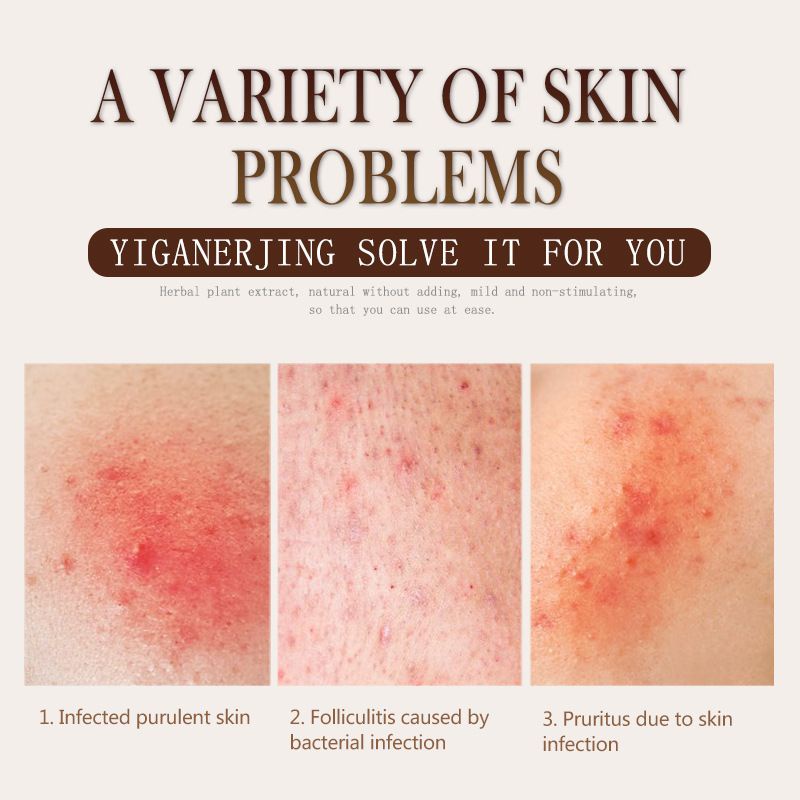 Yiganerjing Salep Obat Eksim Gatel Gatal - Kulit Jamur Herbal Dermatitis Psoriasis Eksim-4