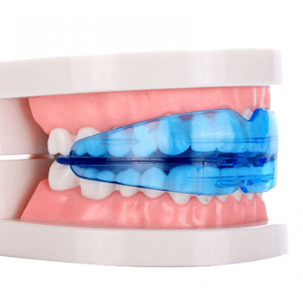 [BIRU] Perapi Gigi Tanpa Behel dari Bahan Silikon Bukan Kawat l Orthodentic Retainer Teeth Phase 1