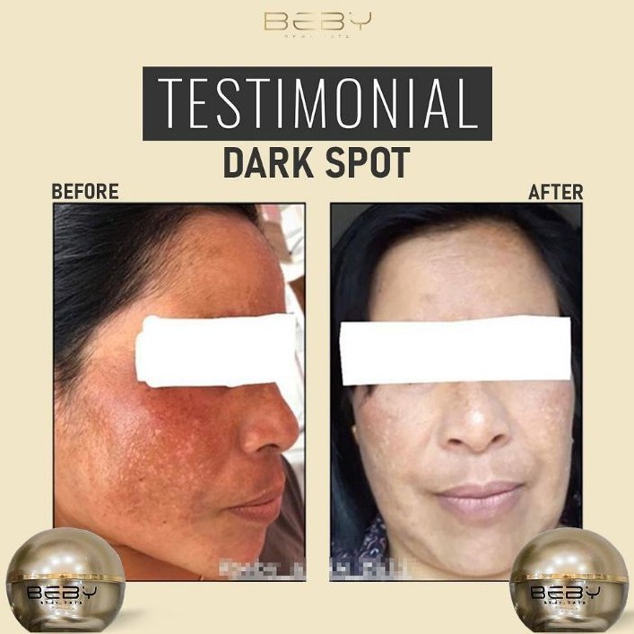 PROMO MURAH DARK SPOT( ANTI FLEK)