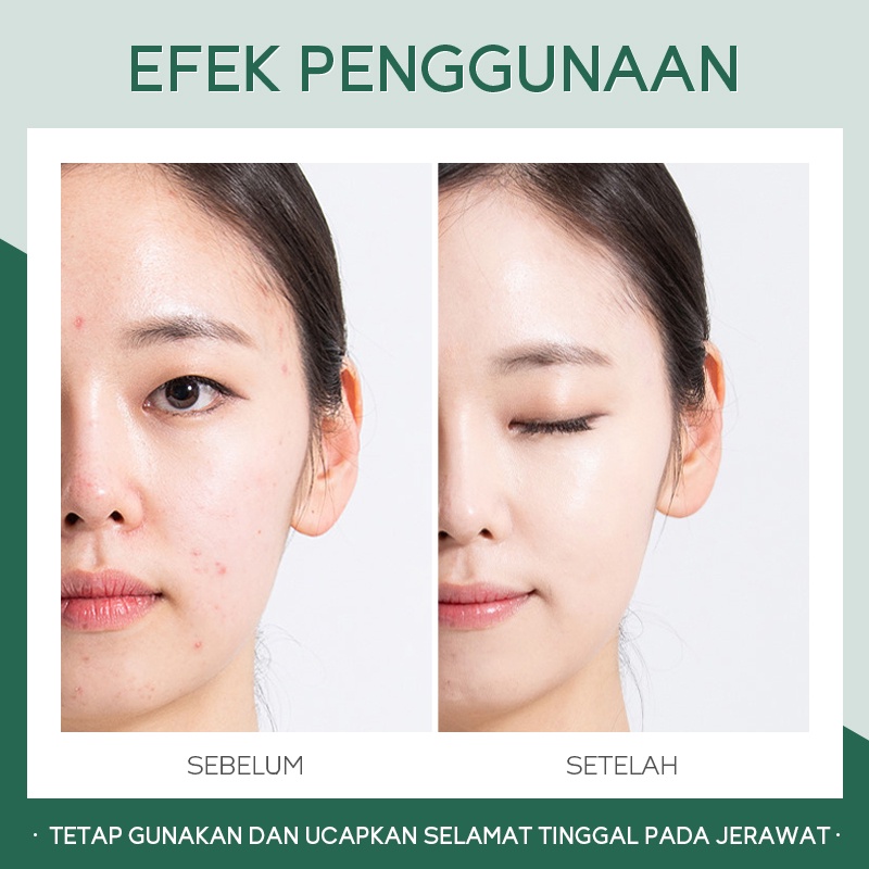 Fenyi Tea Tree Fade Acne Marks Gel Menenangkan Kulit Wajah Anti-inflamasi 20g