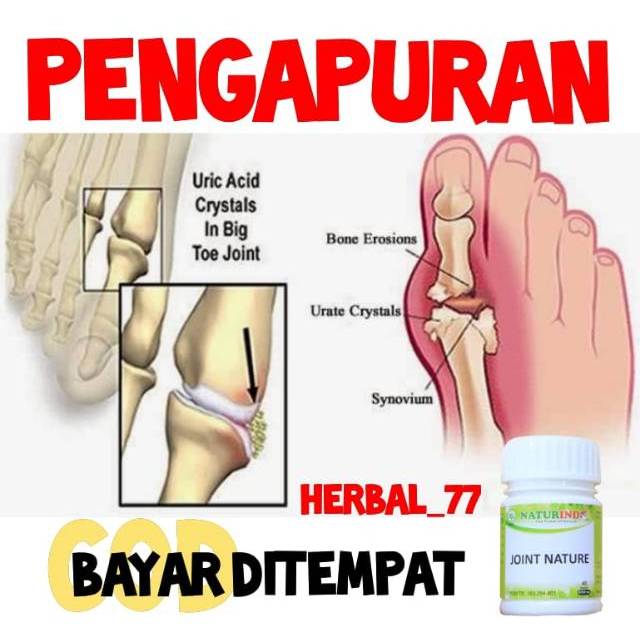 

Obat Herbal Naturindo PENGAPURAN SENDI / RADANG , PENGAPURAN TULANG, TULANG KEROPOS, OSTEOPOROSIS co