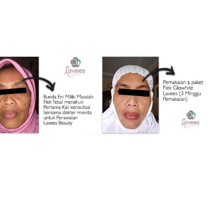 ➼ [SERUM FLEK & MELASMA] Lavees Concentrate Glowhite Serum Essence ➣