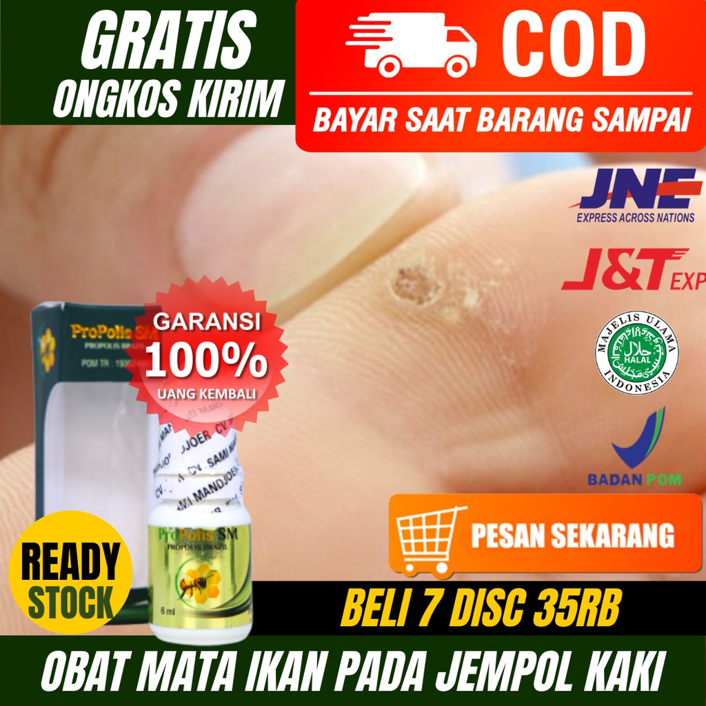 Obat Tetes Mata Ikan Pada Jempol Kaki_Mata Ikan Menahun_Obat Mata Ikan Sakit & Bengkak_Propolis SM