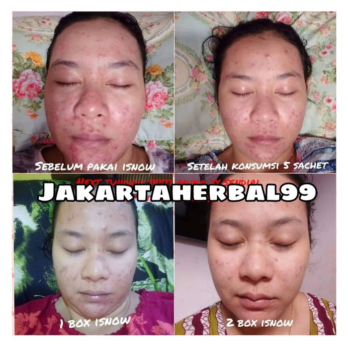 Perawatan Tubuh - Kecantikan - Perawatan Kulit Isnowalgae - Pencerah - Bebas Jerawat - Flek - Kusam