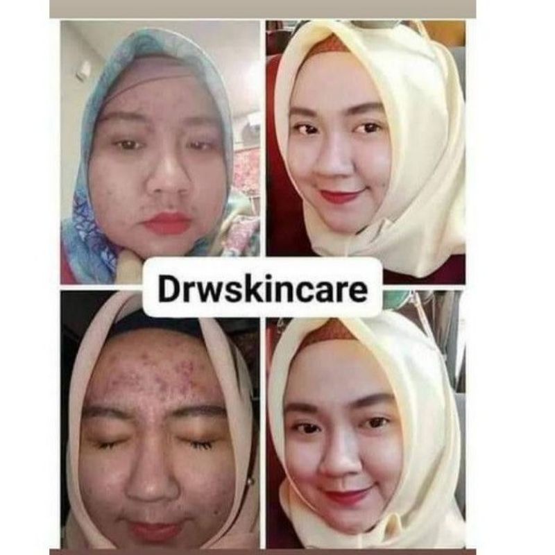 RADIANT ACNE DRW SKINCARE ORI Bpom