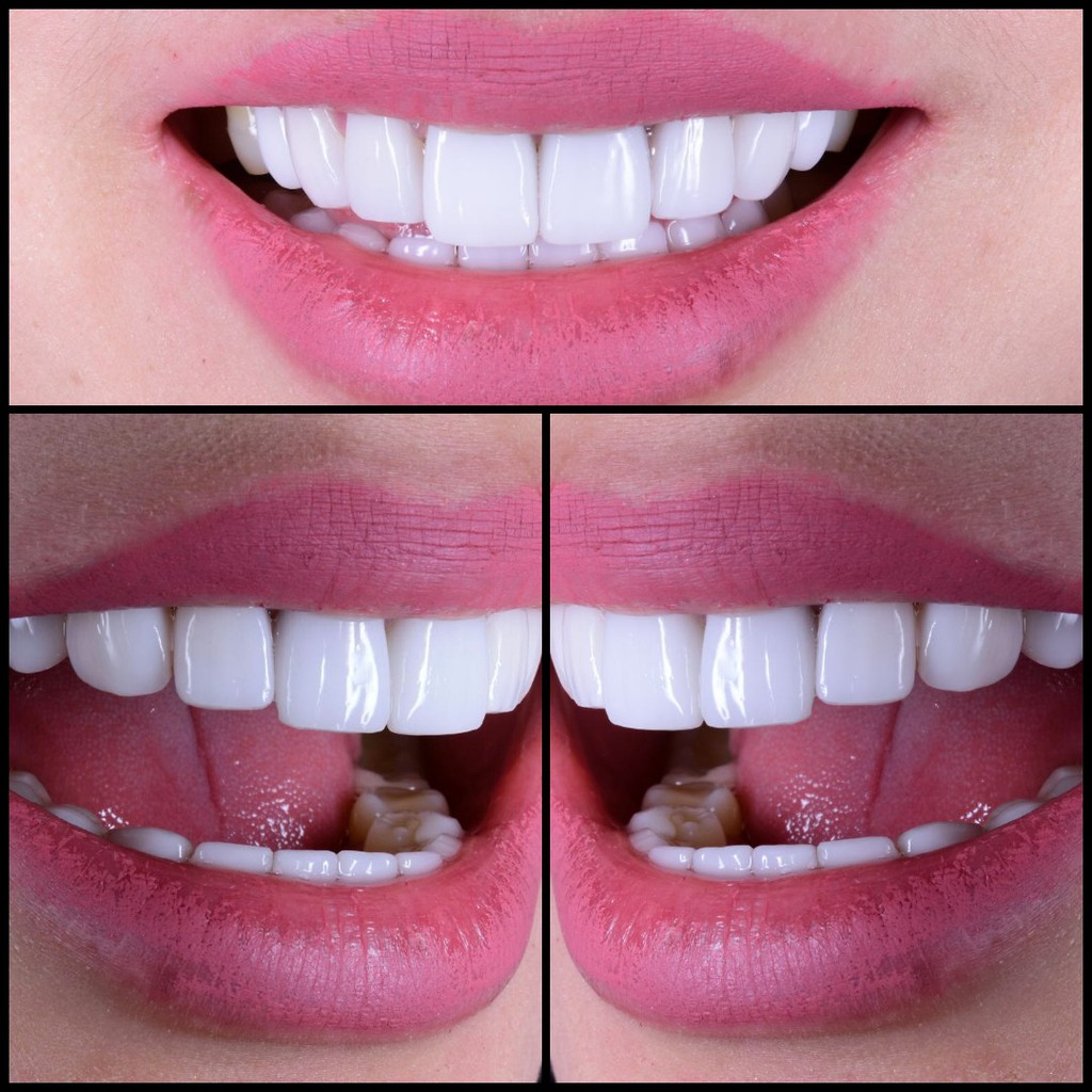 Veneer Gigi / Vener / Veneers / Gigi Kelinci Original / Teeth isi 6 Behelldental