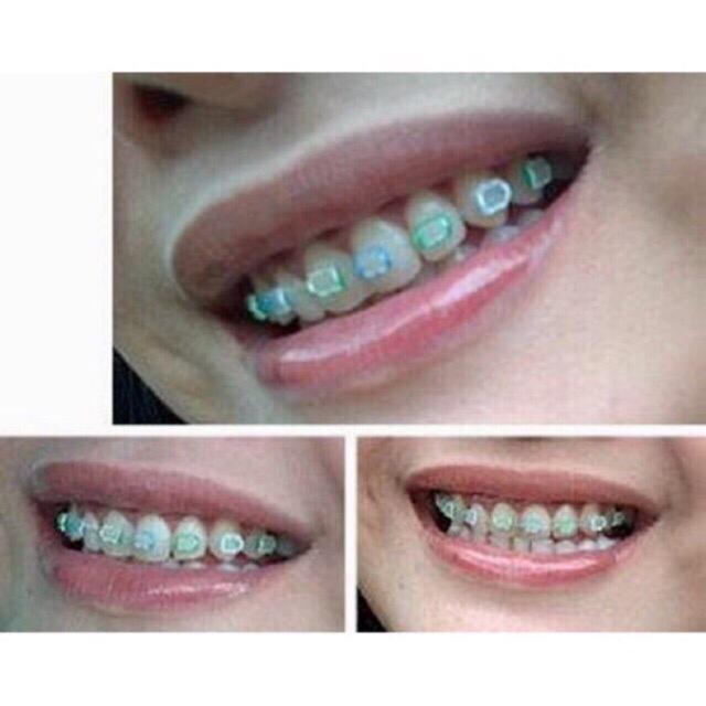 ✿ELYSABETHME✿ Behel lepas pasang perapi gigi murah higienis aksesoris teeth