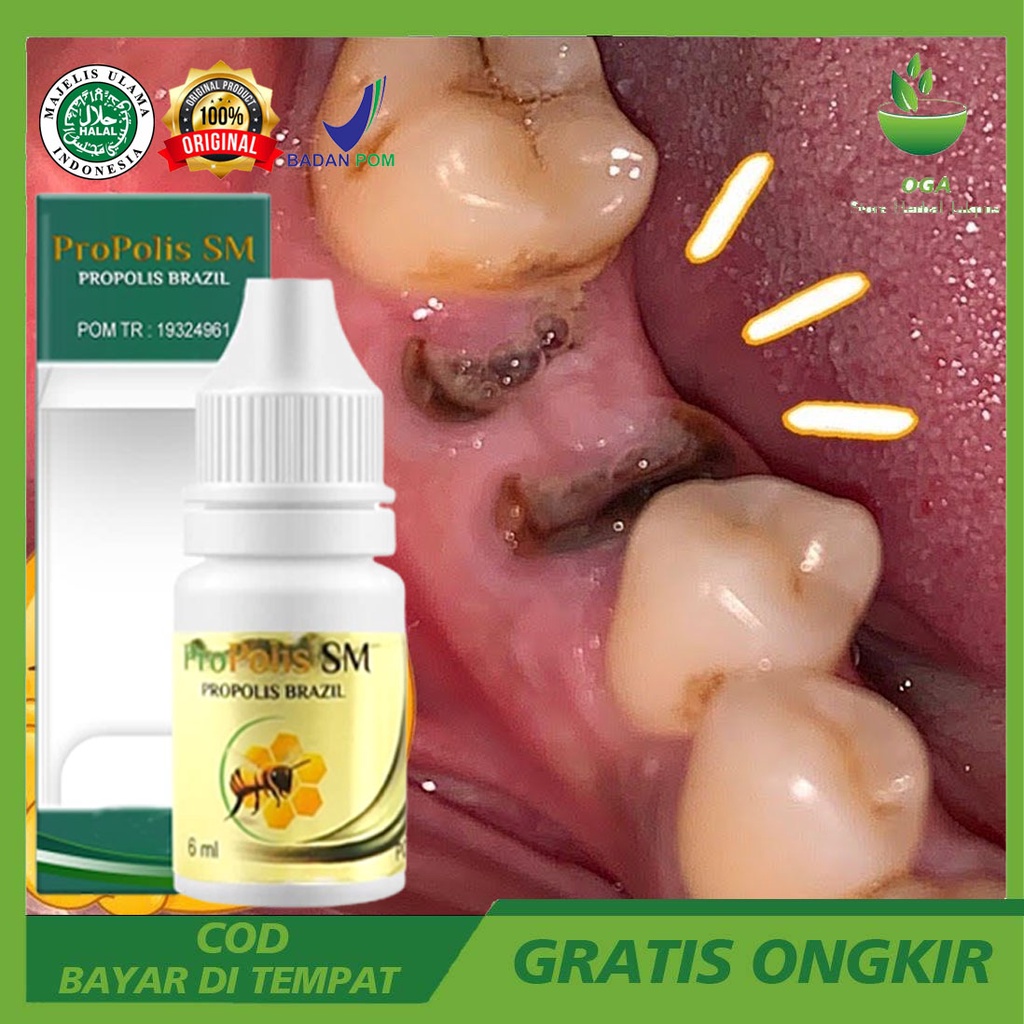 Obat Perontok Akar Gigi Berlubang Perontok Gigi Sampai Ke Akar Gigi Berlubang Agar Cepat Sembuh Peng